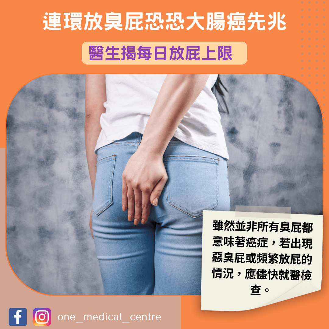 【連環放臭屁恐恐大腸癌先兆　醫生揭每日放屁上限】